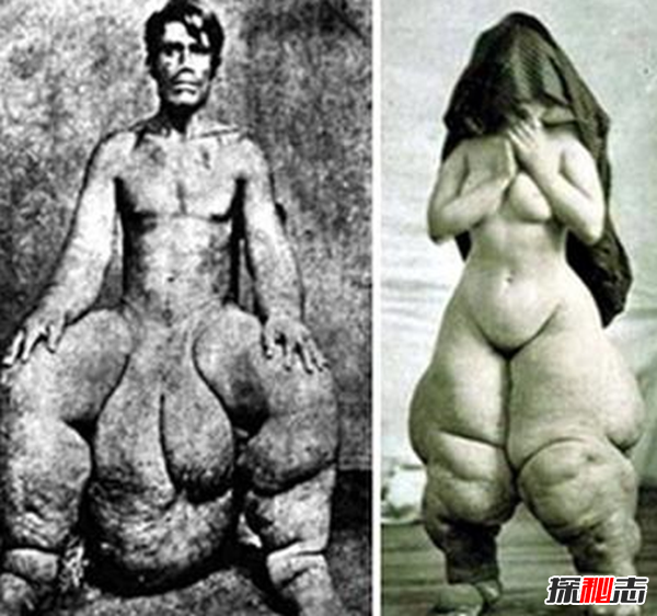惊人!象皮病是什么病?象皮病可以治愈吗(慢性人体寄生虫病)