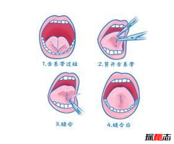 如何矫正大舌头?怎样判断是不是大舌头(吐字不清)