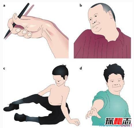中国世界首例舞蹈猪,亨廷顿氏舞蹈症是什么病?