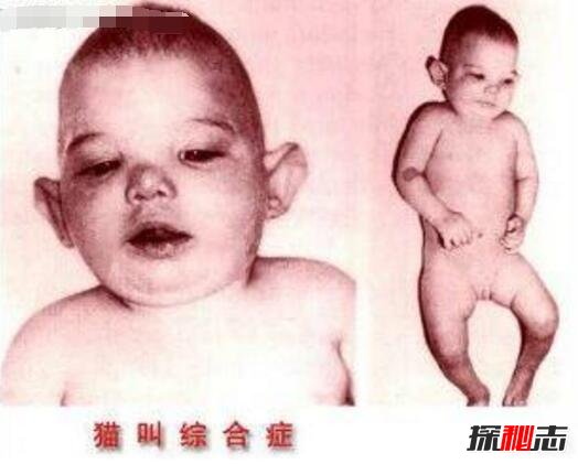 猫叫综合症的临床表现是什么？猫叫综合症能活多久