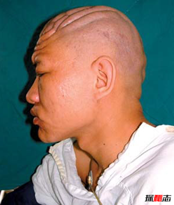 广州女孩患骨膜增生厚皮症,面部褶皱如古稀老人(染色体显性遗传)